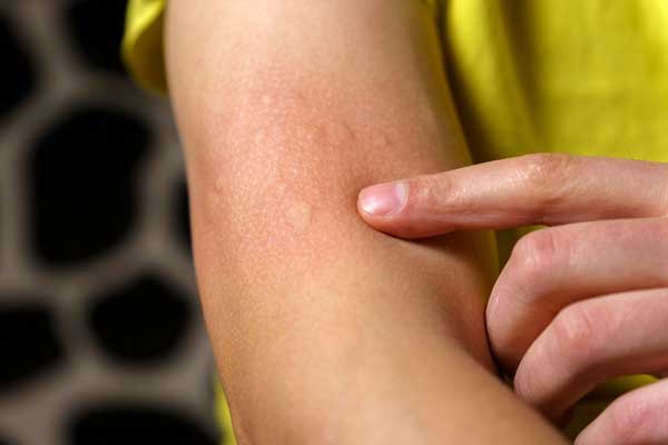 Treating Those Extremely Itchy and Irritating Hives (Urticaria)