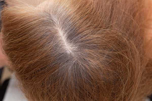Holistic Hair Regrowth: Natural Solutions for Thinning Hair